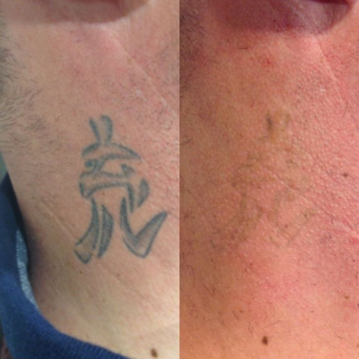 Cosmetic tattoo removal